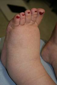 Figure 5a – Primary lymphoedema of the foot